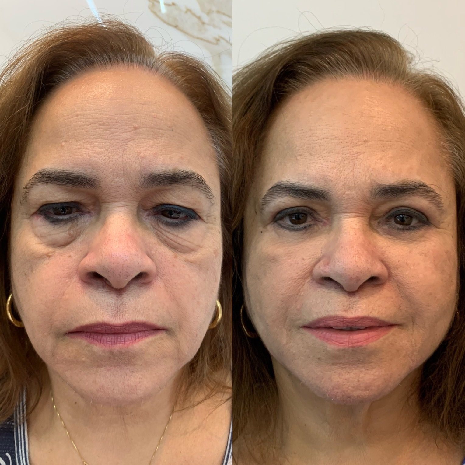 Antes e depois de blefaroplastia sem cortes, com redução da flacidez ao redor dos olhos
