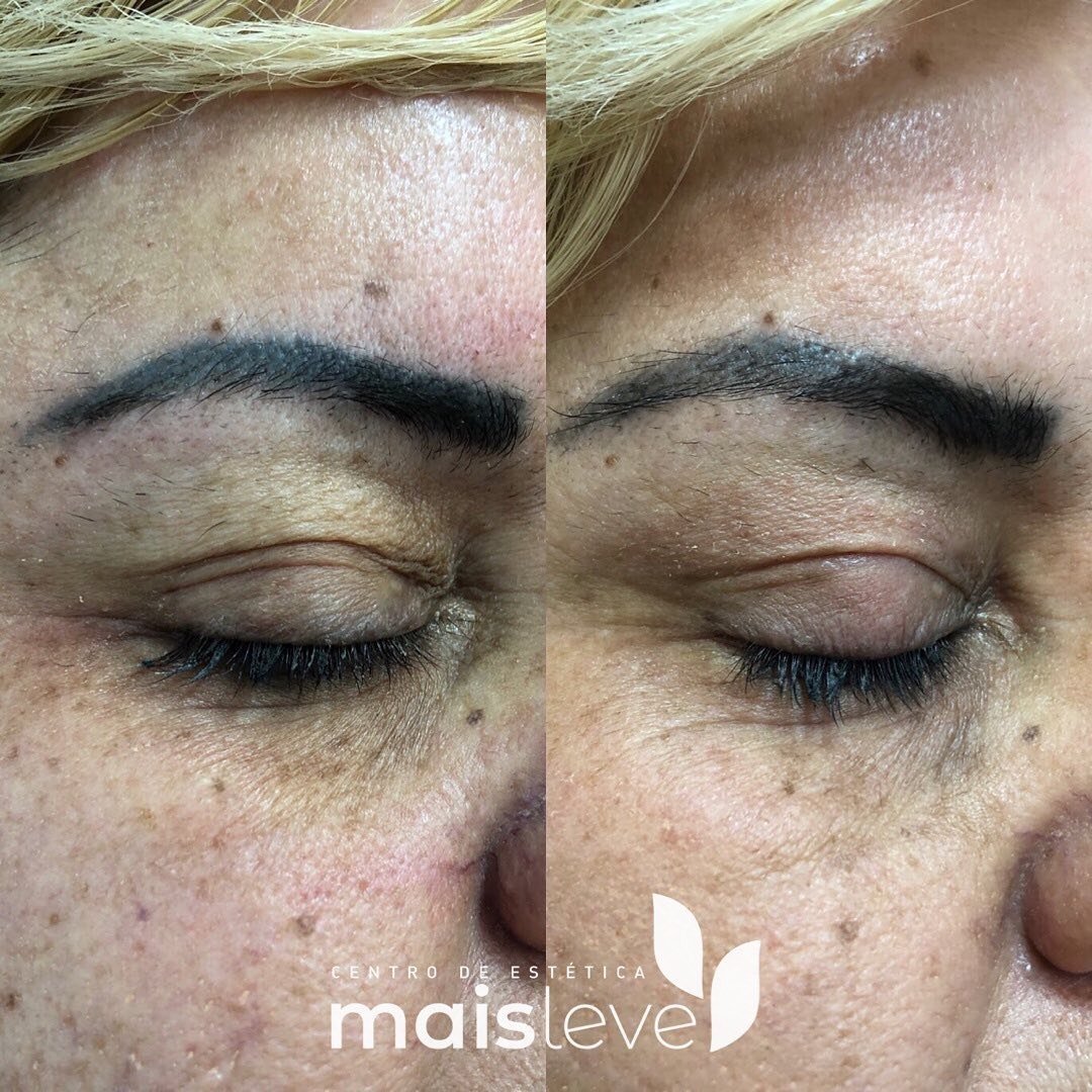 Antes e depois de blefaroplastia sem cortes, com redução da flacidez da pálpebra