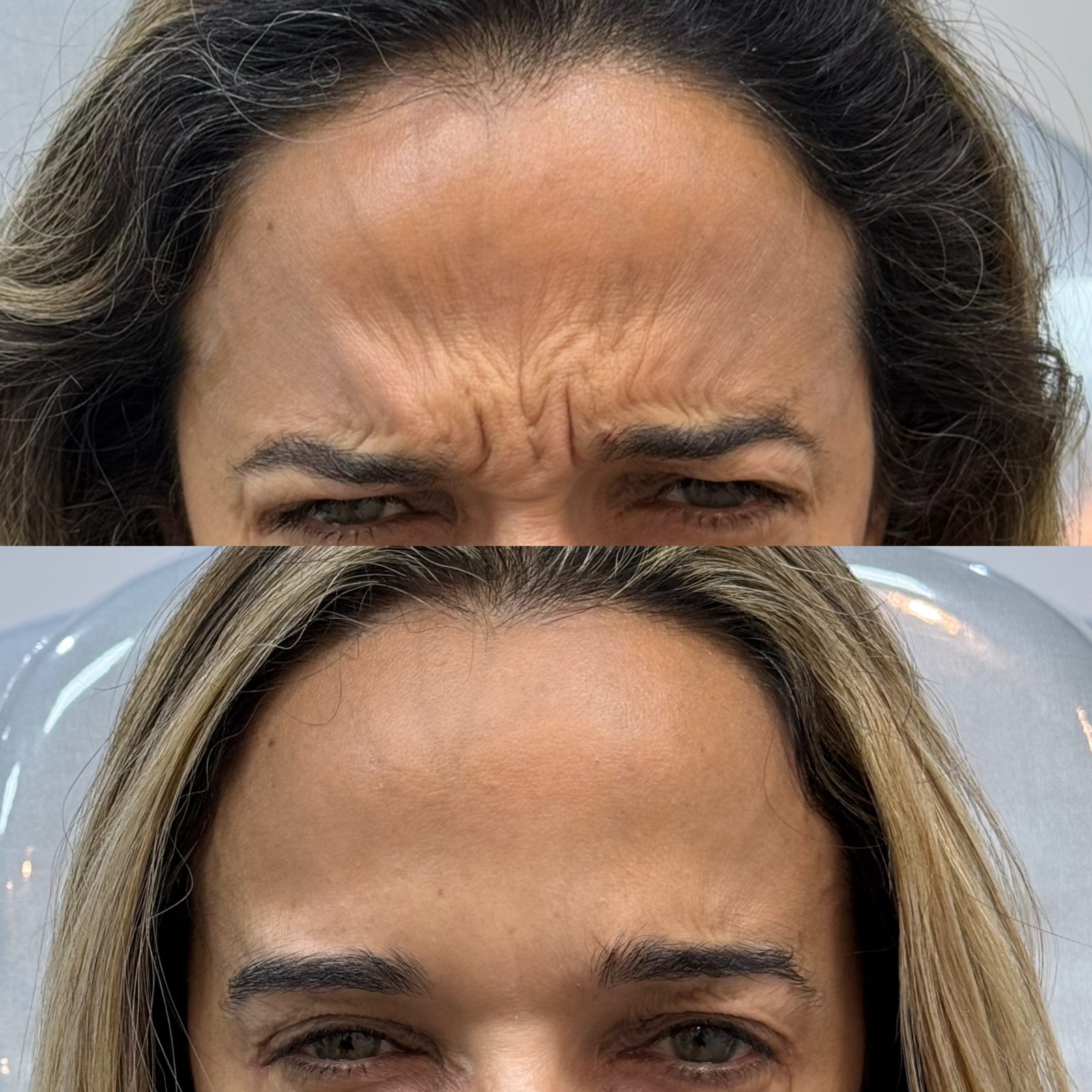 Antes e depois de aplicação de toxina botulínica na testa, com suavização das linhas de expressão