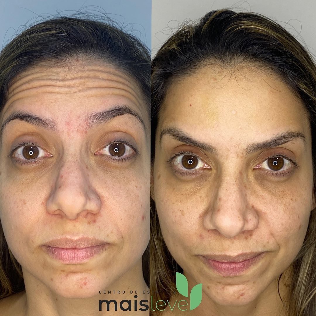 Antes e depois de toxina botulínica na testa, com suavização das rugas de expressão