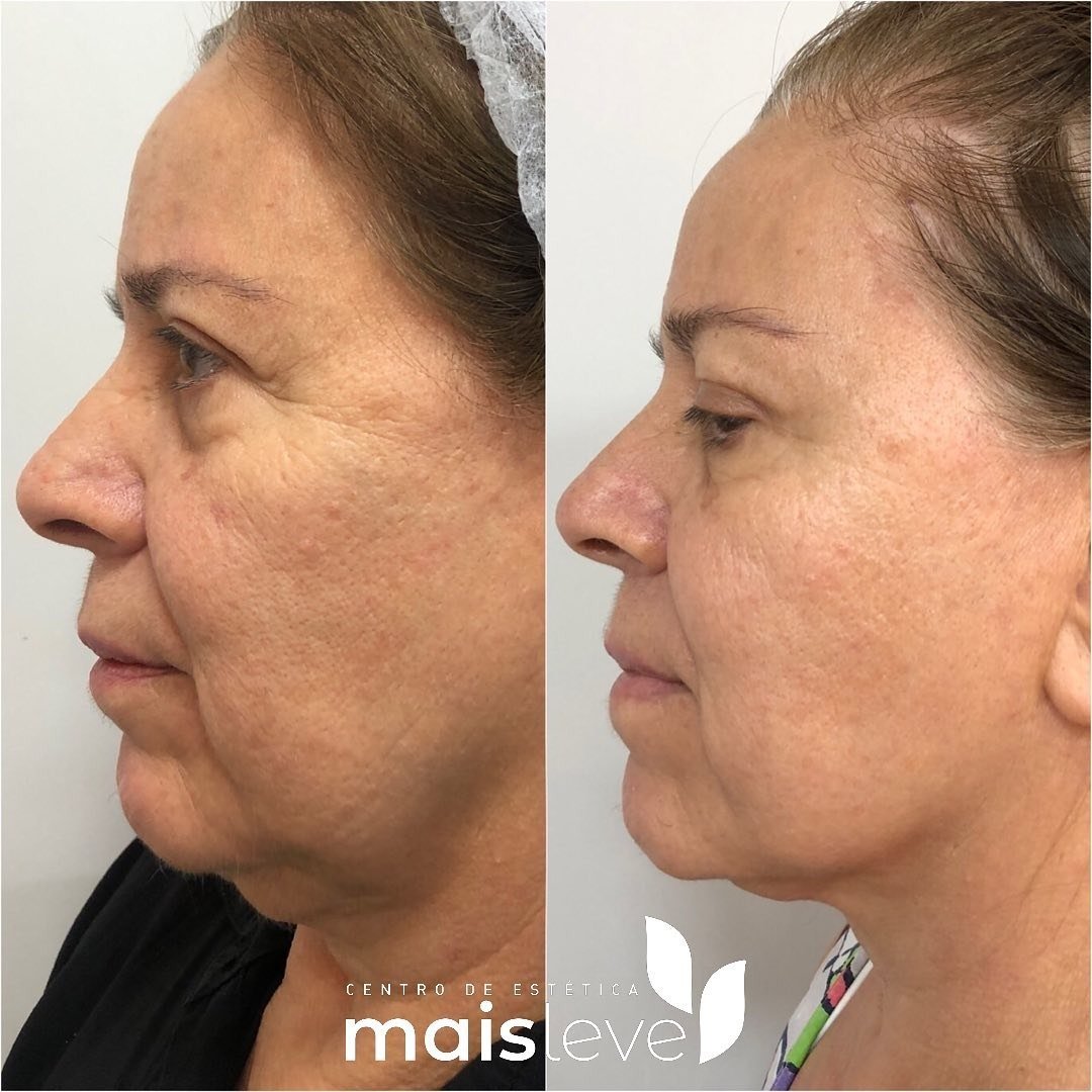 Antes e depois de lifting facial com HERUS HIFU 4D, vista de perfil