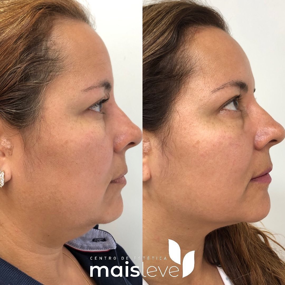 Antes e depois de lifting facial com HERUS HIFU 4D, com melhora do contorno da mandíbula