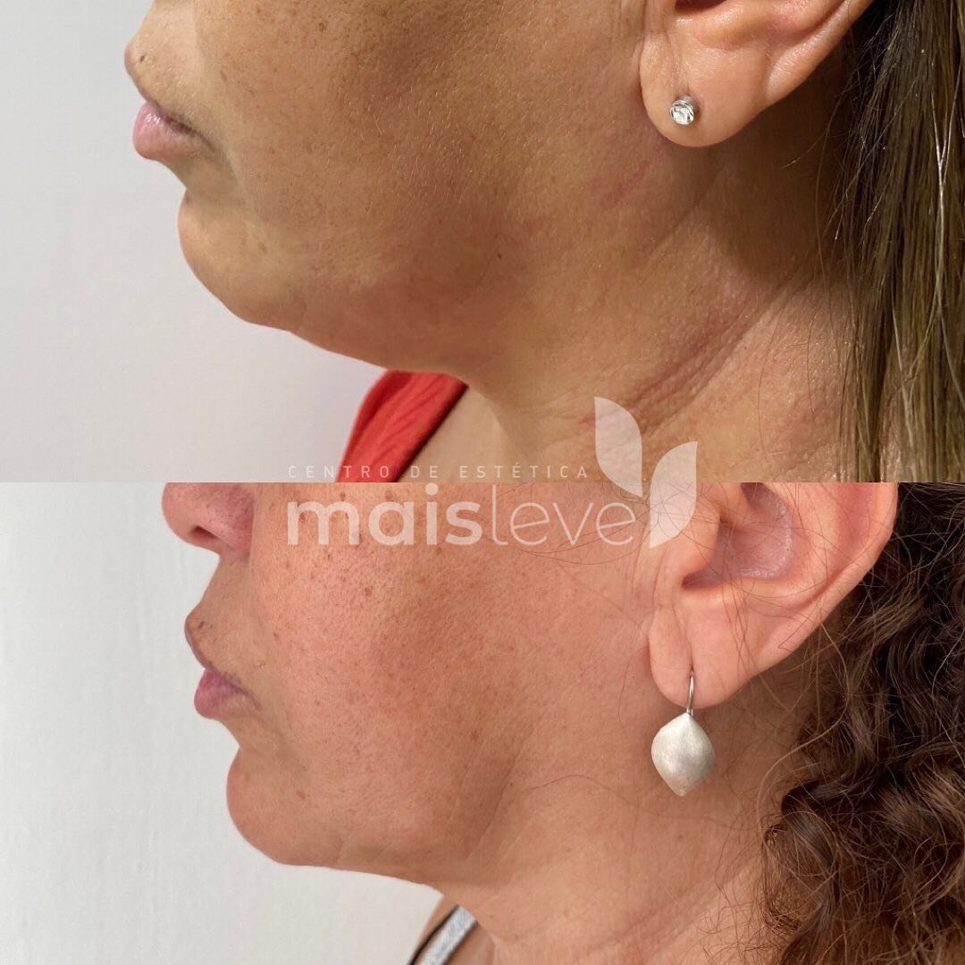 Antes e depois de lifting facial com HERUS HIFU 4D, vista do pescoço e queixo