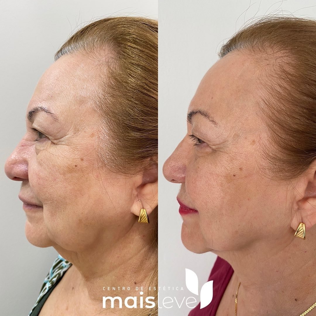 Antes e depois de lifting facial com HERUS HIFU 4D, vista de perfil
