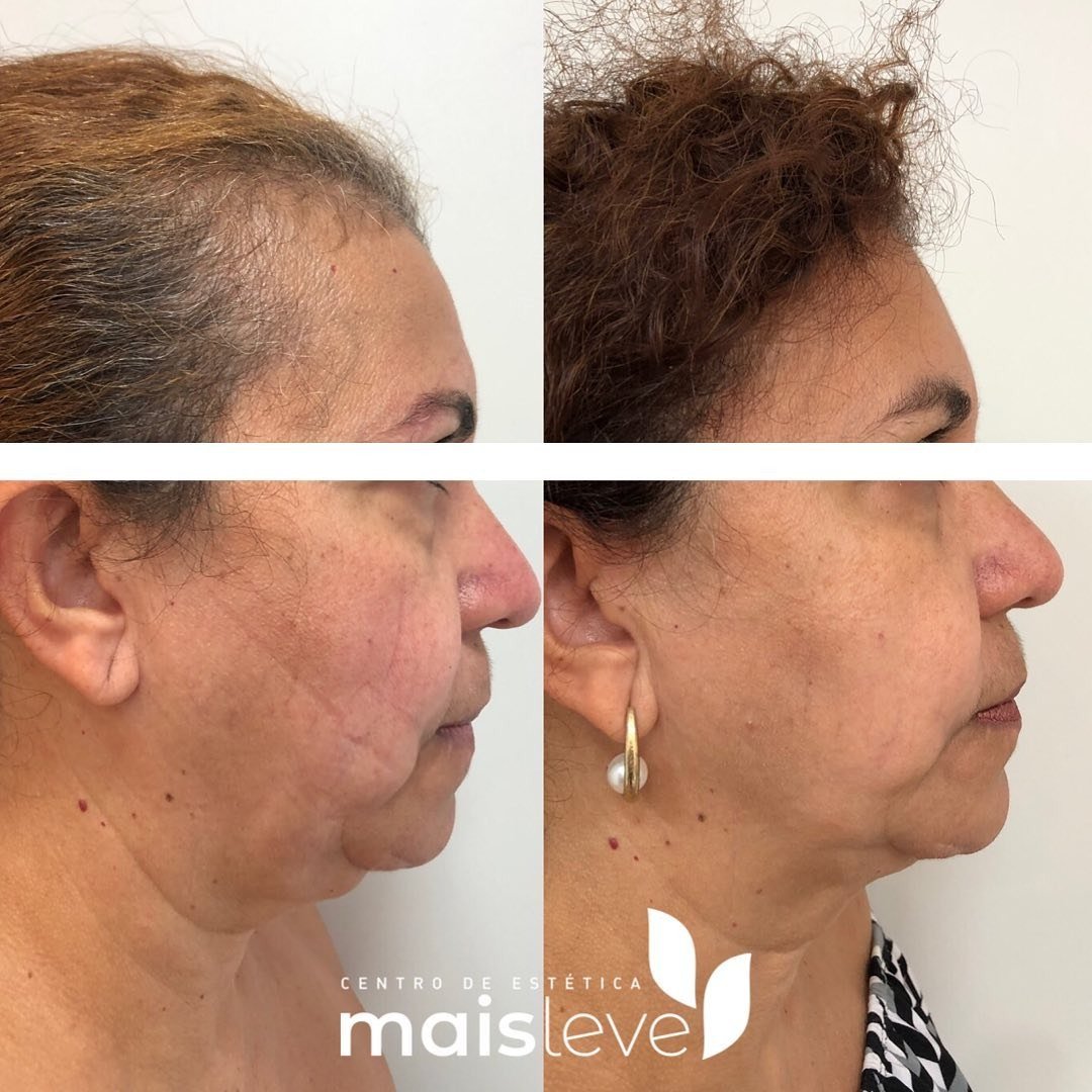 Antes e depois de lifting facial com HERUS HIFU 4D, testa e perfil do rosto