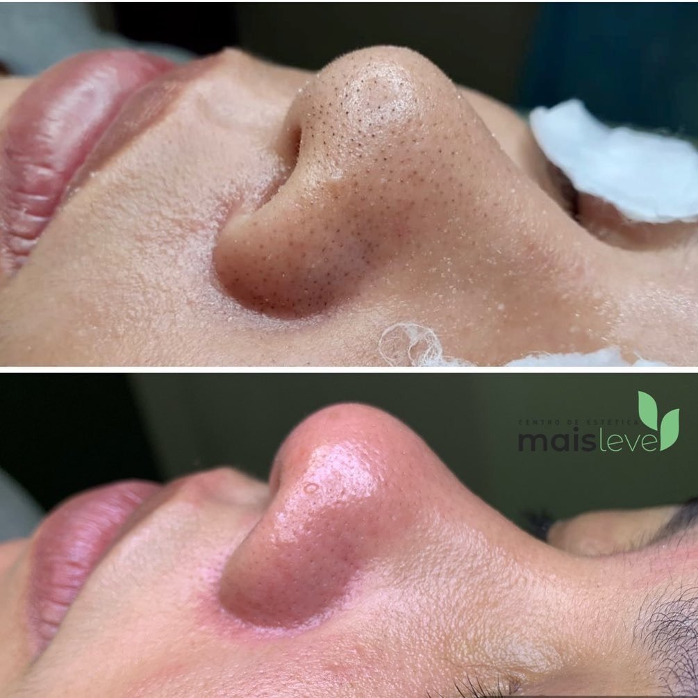 Antes e depois de limpeza de pele, com remoção de cravos do nariz