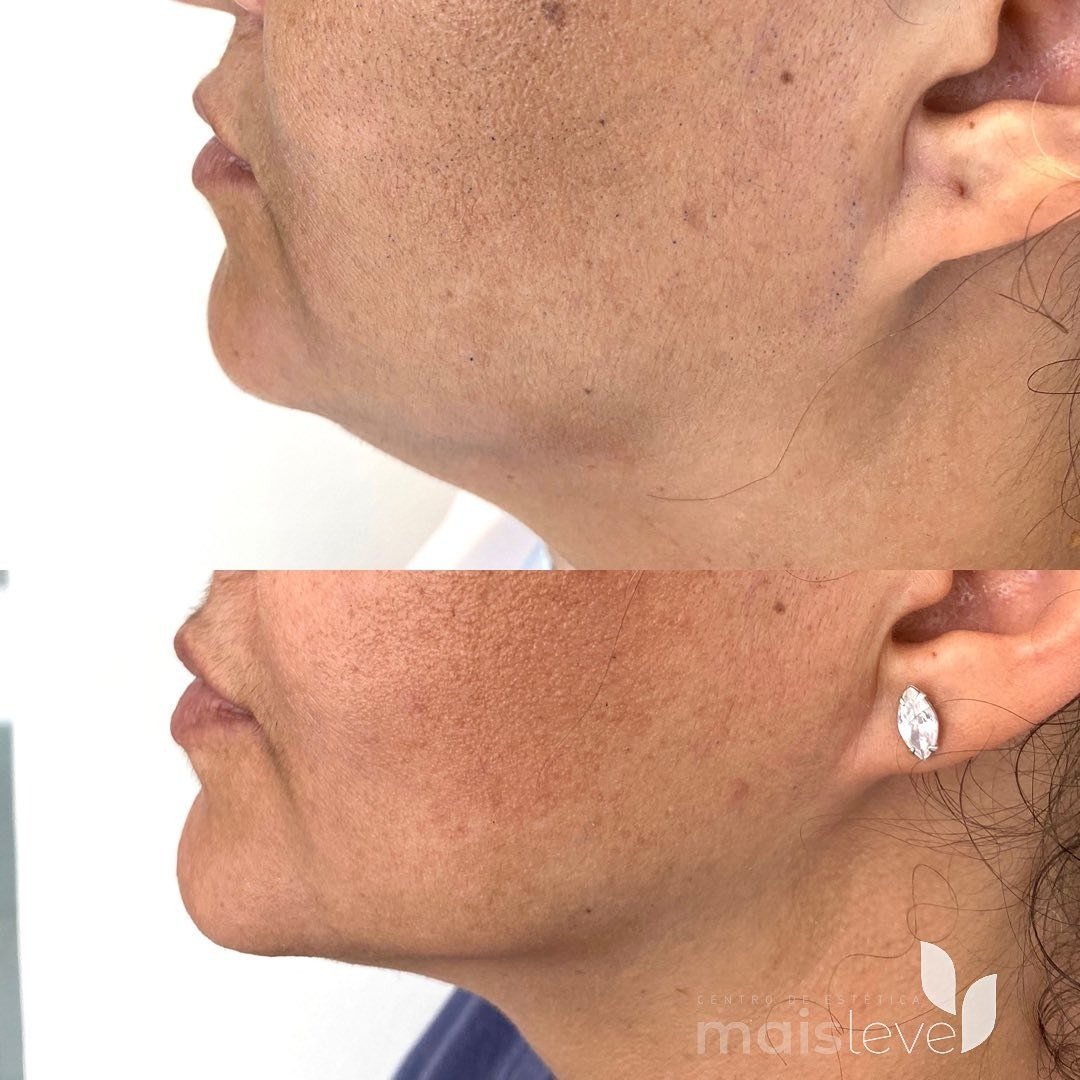 Antes e depois de lipo de papada sem cortes, vista de perfil do queixo