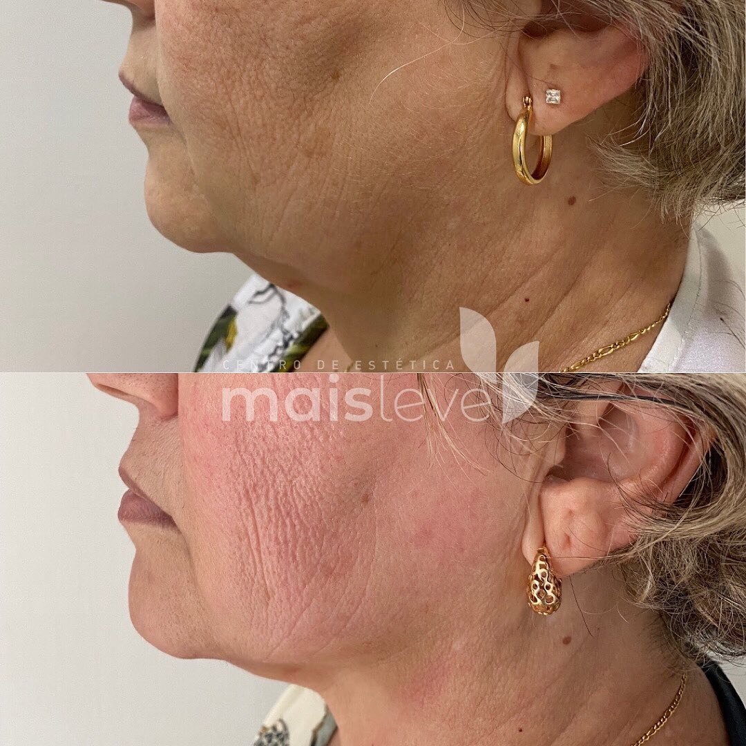 Antes e depois de lipo de papada sem cortes, com refinamento da linha da mandíbula