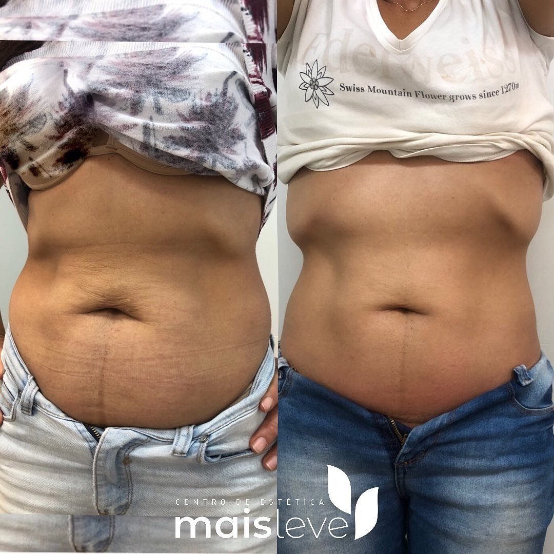 Antes e depois de lipo sem cortes no abdômen, vista frontal
