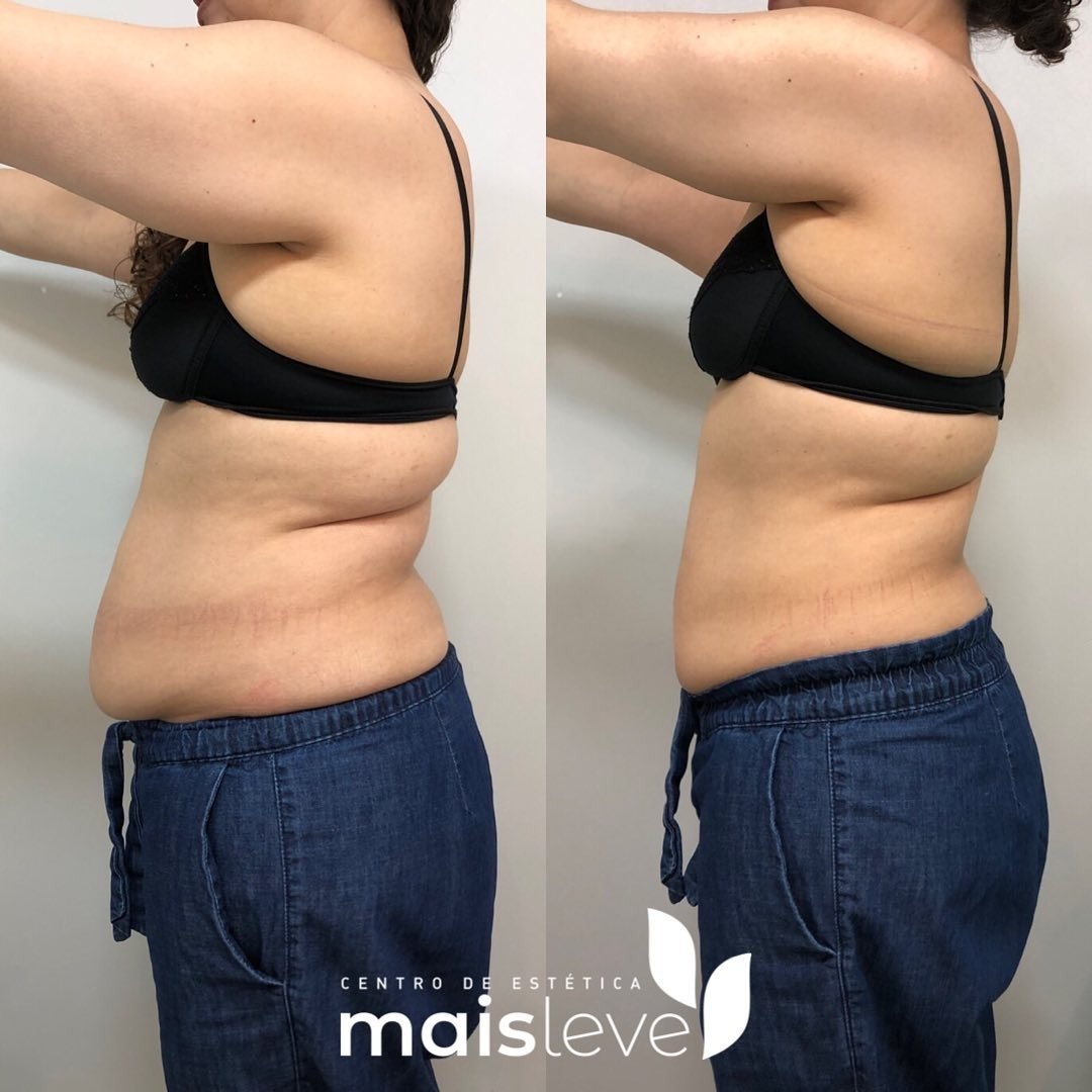 Antes e depois de lipo sem cortes no abdômen, vista de perfil