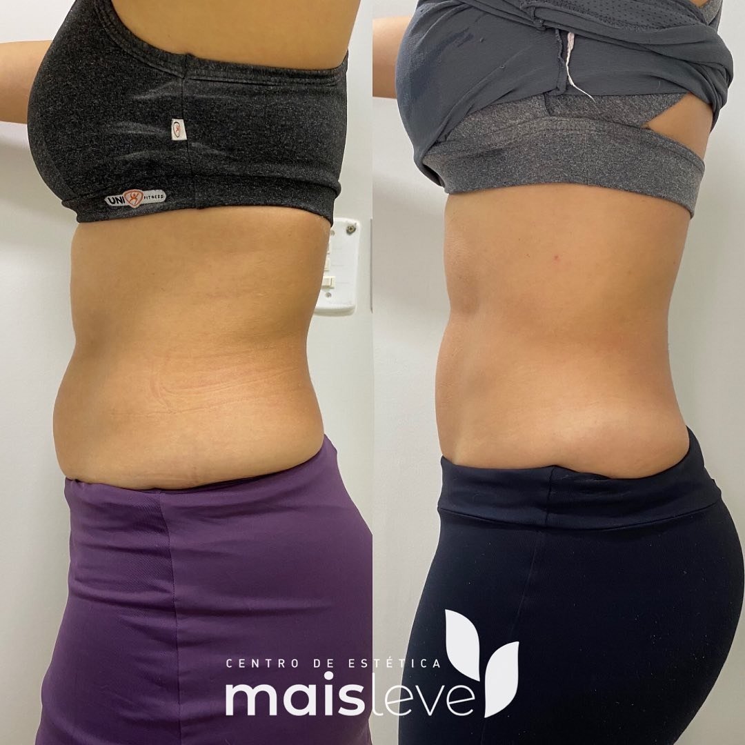 Antes e depois de lipo sem cortes na lateral do abdômen