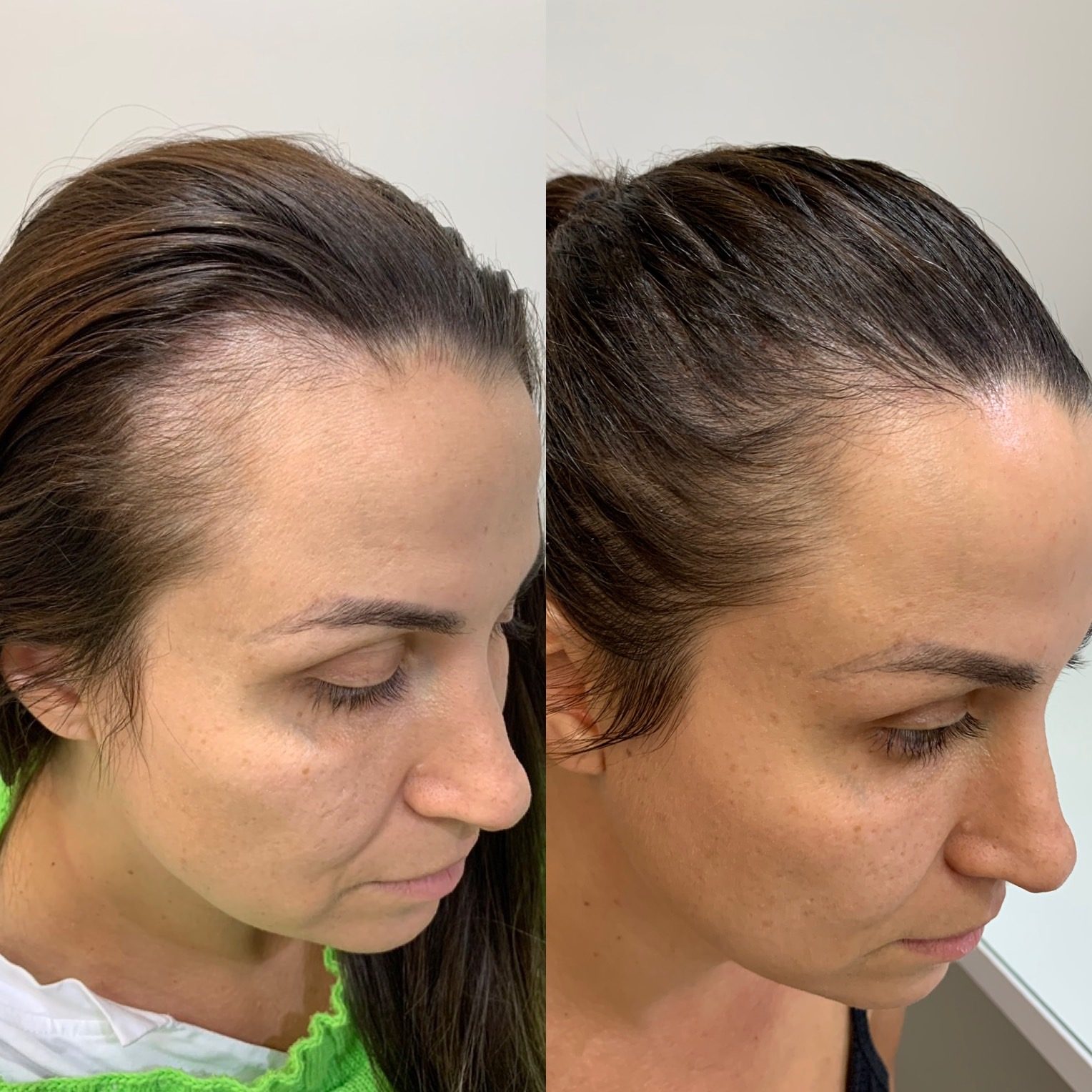 Antes e depois de mesoterapia capilar, com aumento da densidade dos fios na linha do cabelo