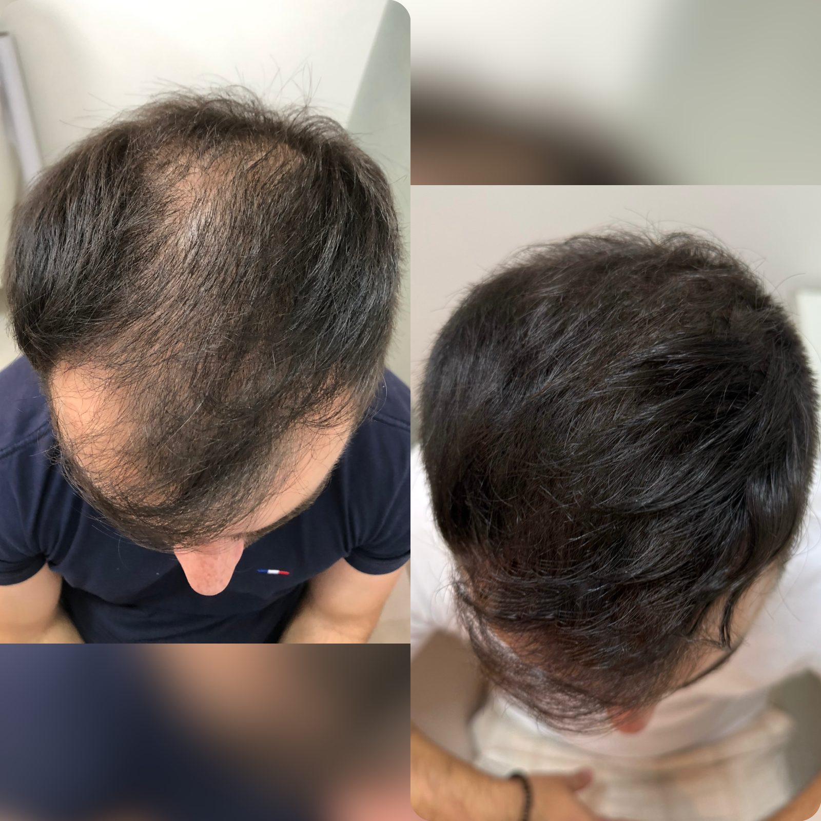 Antes e depois de mesoterapia capilar, vista superior do couro cabeludo
