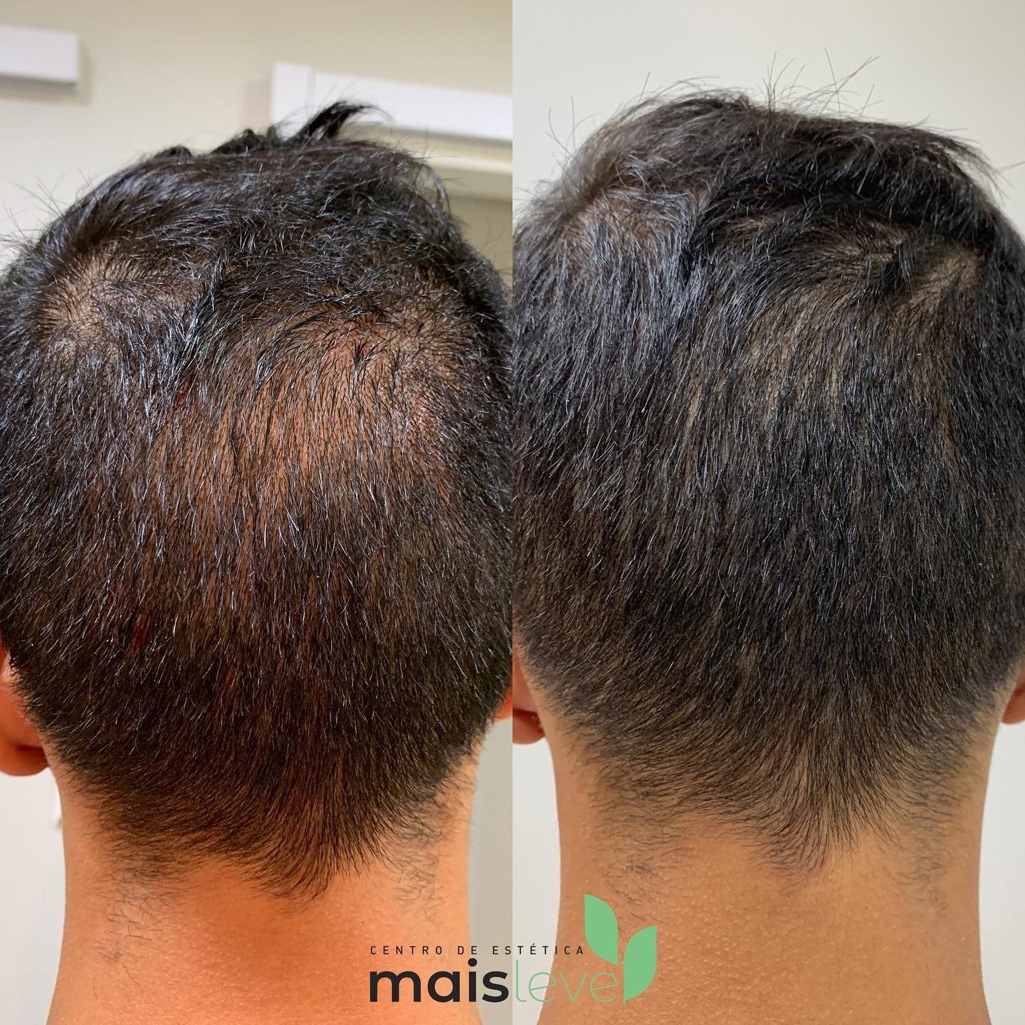 Antes e depois de mesoterapia capilar, vista de trás do couro cabeludo