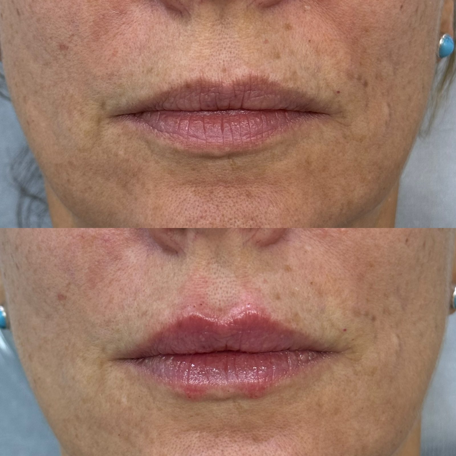 Antes e depois de preenchimento labial com ácido hialurônico