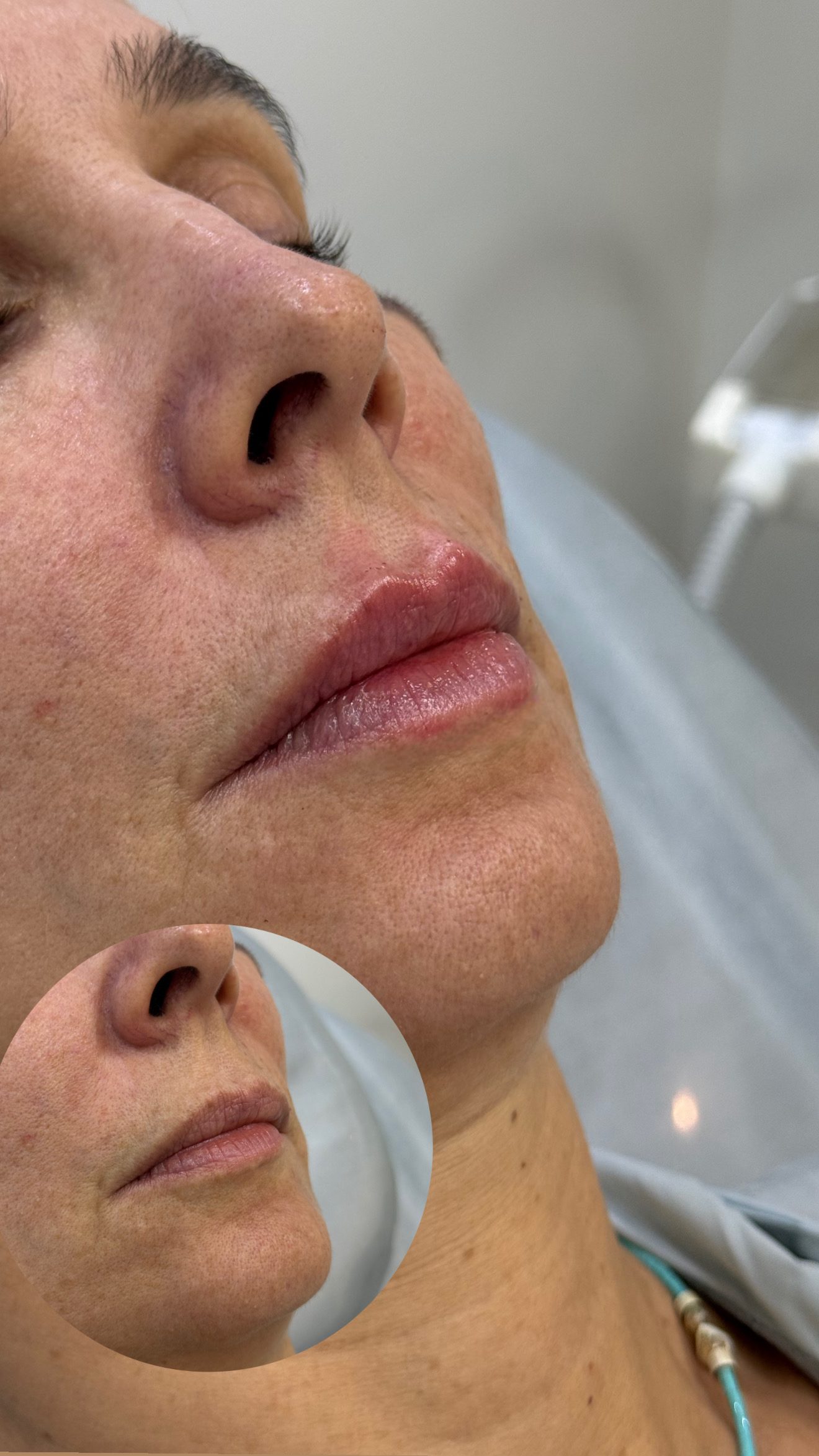 Antes e depois de preenchimento labial, vista de perfil