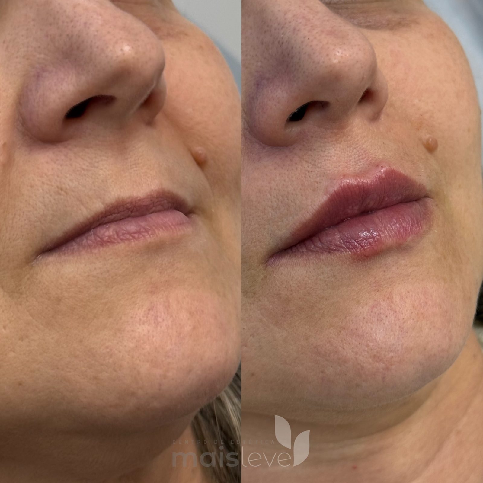 Antes e depois de preenchimento labial