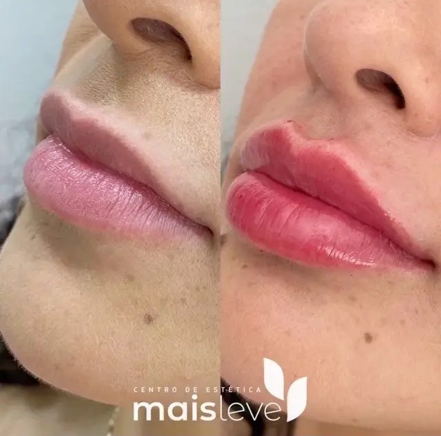 Antes e depois de preenchimento labial, vista de perfil aproximada