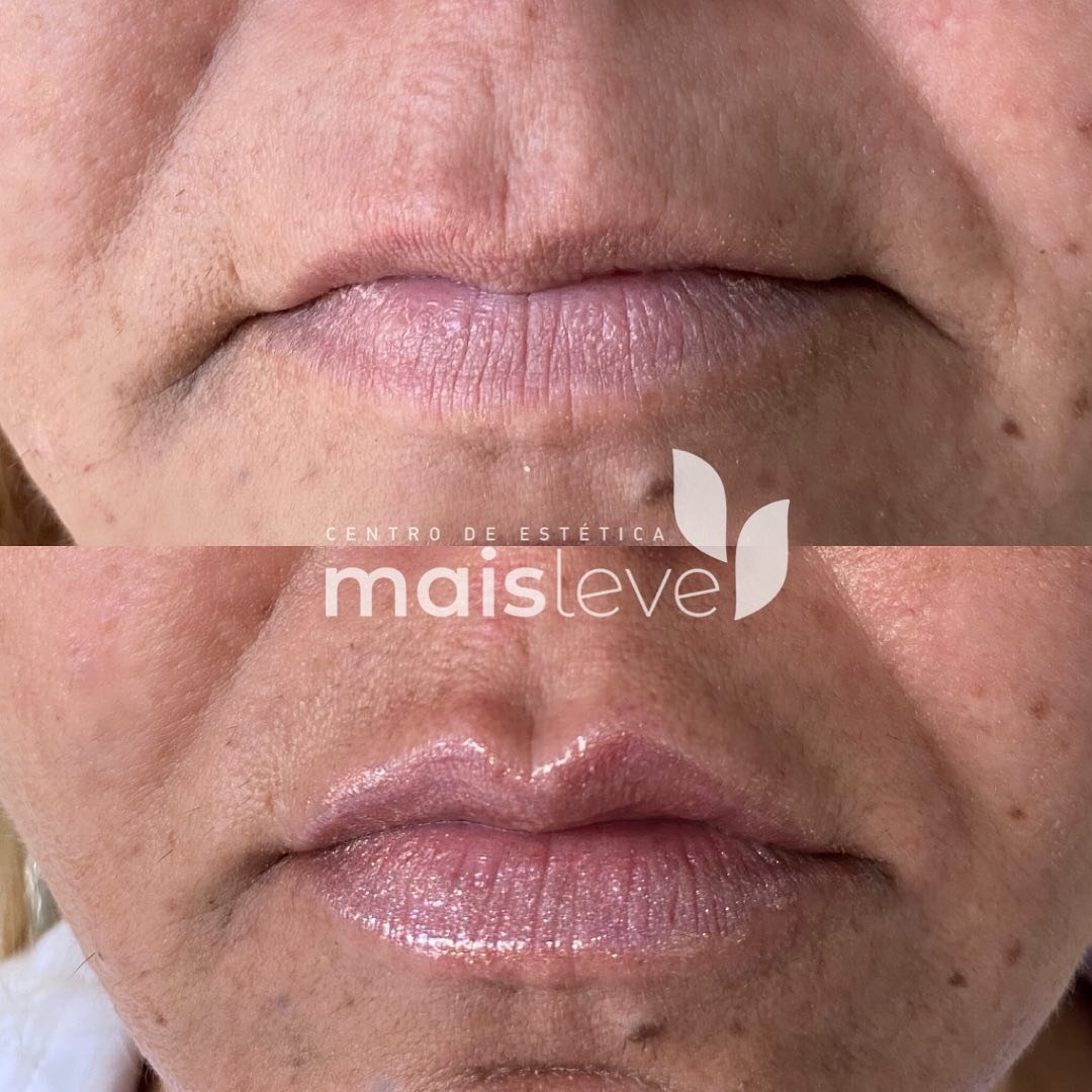 Antes e depois de preenchimento labial, vista frontal