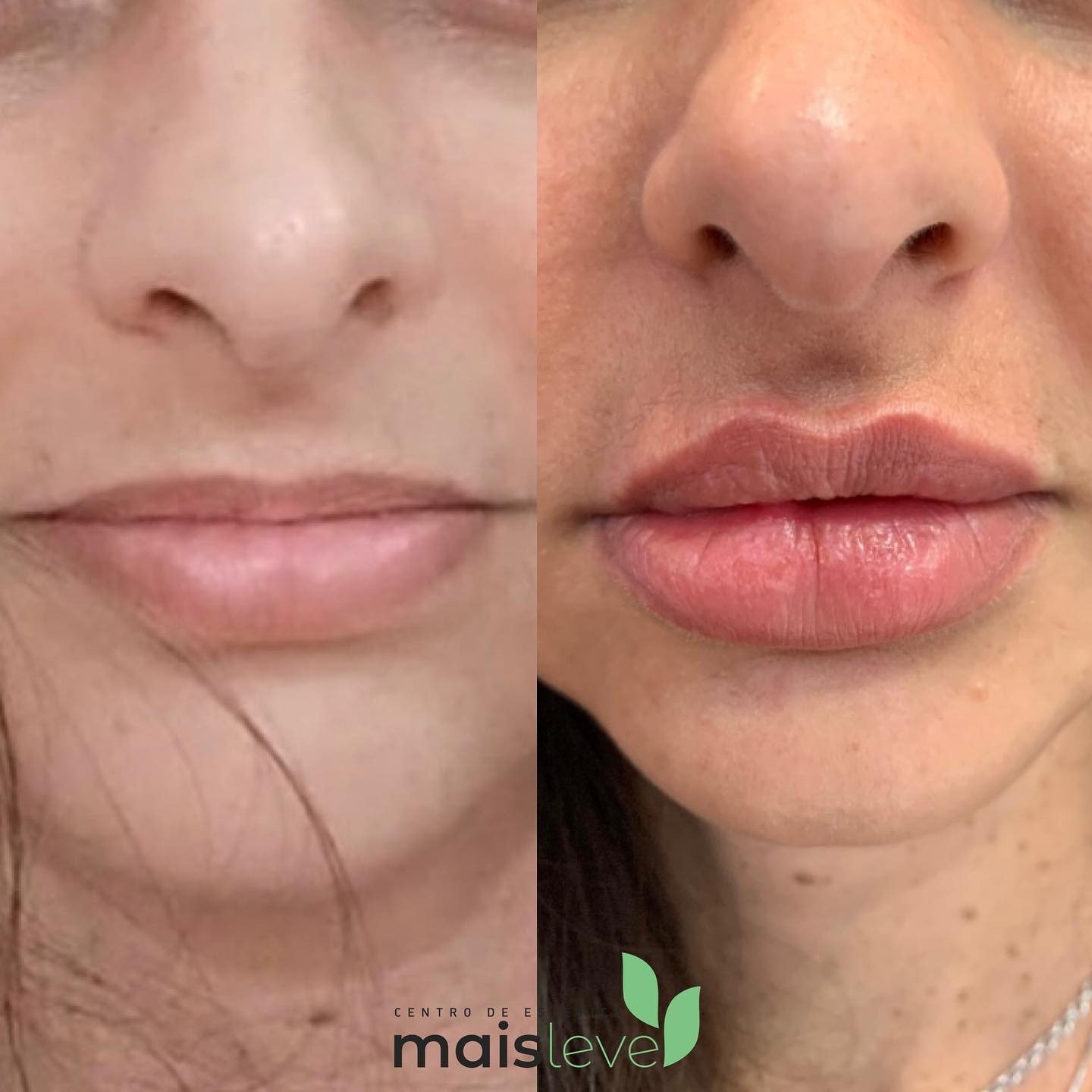 Antes e depois de preenchimento labial com ácido hialurônico, vista frontal aproximada