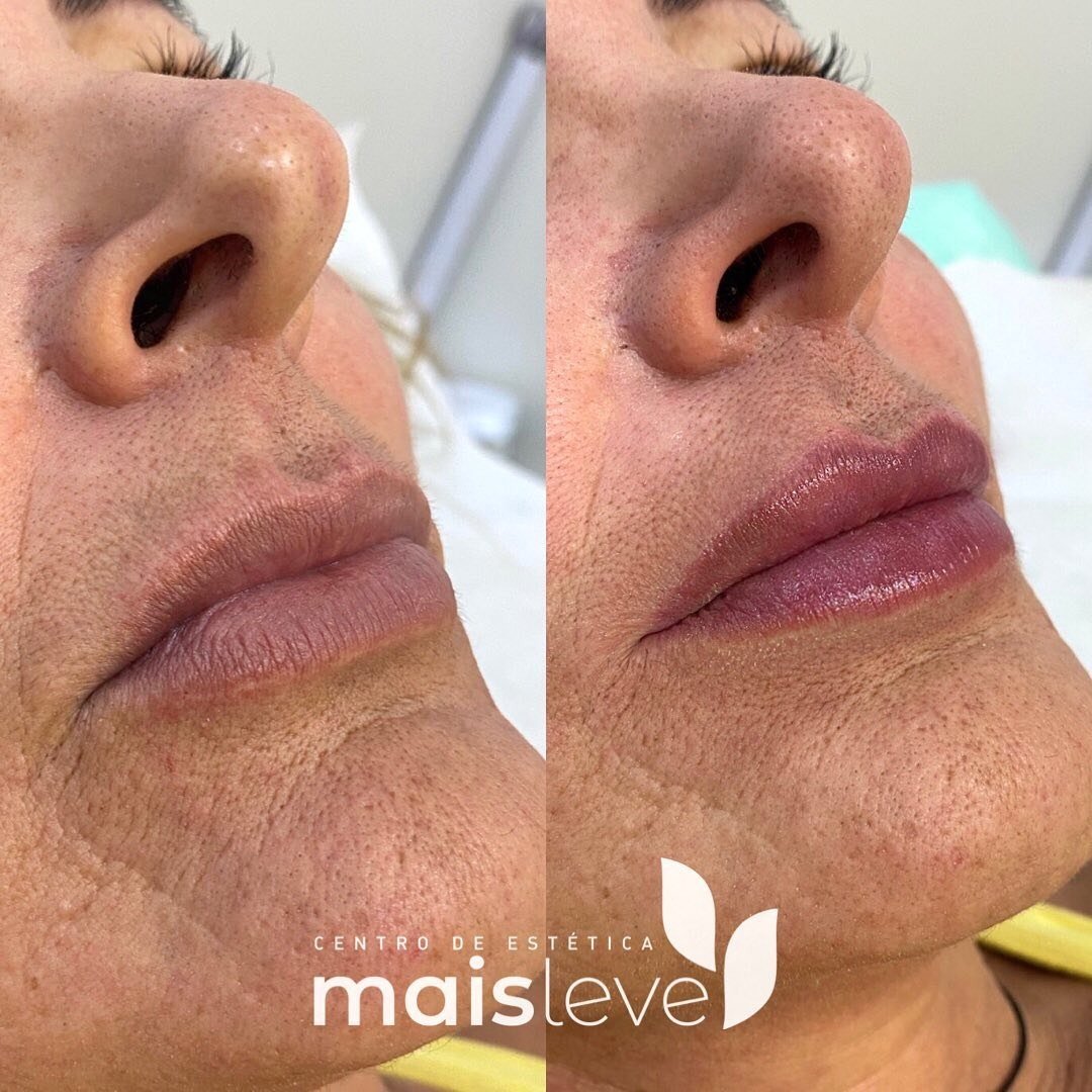 Antes e depois de preenchimento labial, vista de perfil