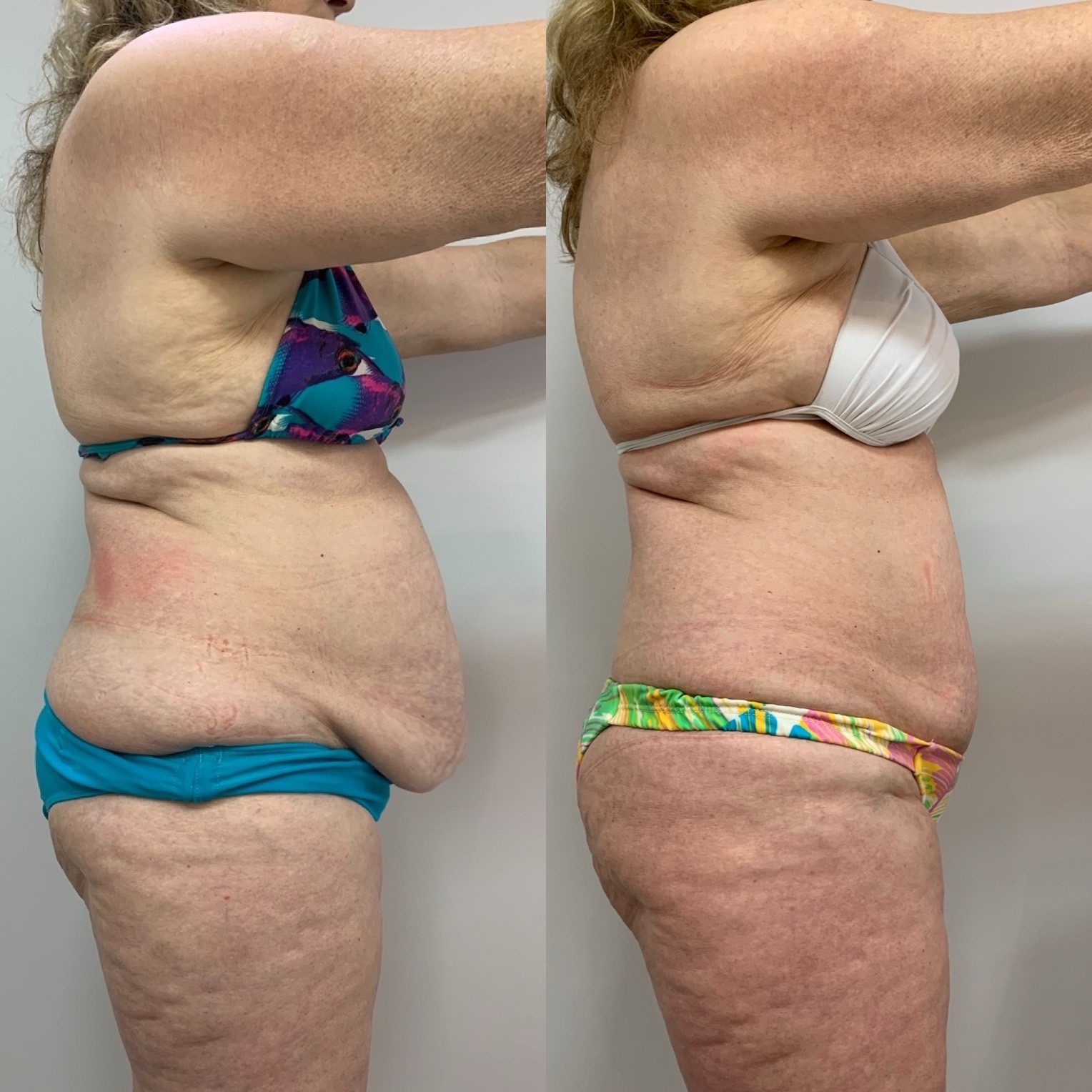 Antes e depois de procedimento corporal, vista de perfil