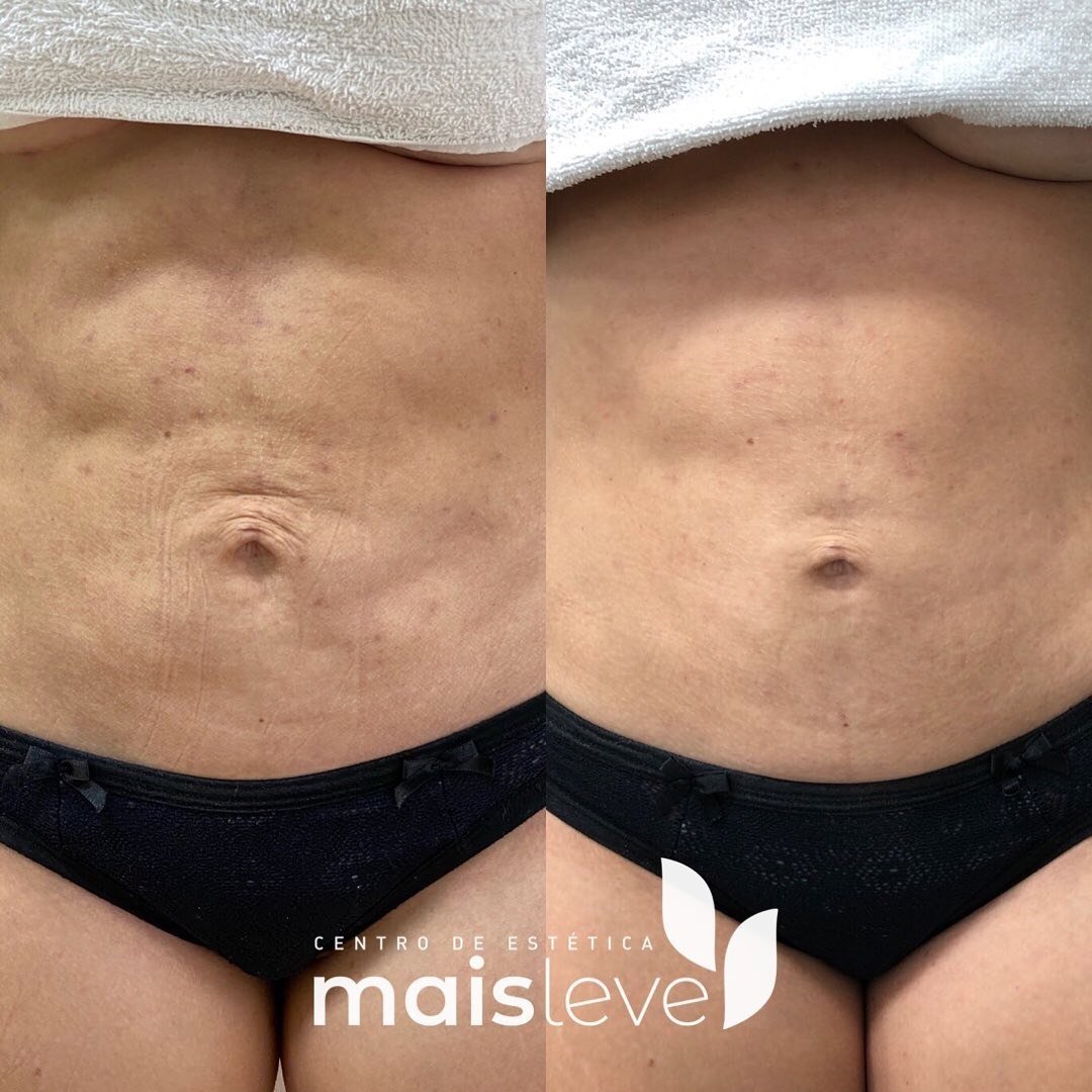 Antes e depois de procedimento corporal no abdômen, com melhora da textura da pele