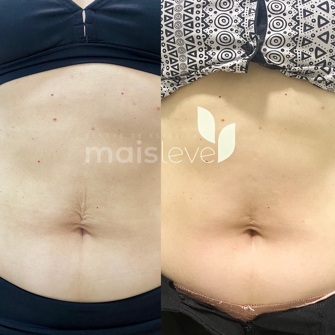 Antes e depois de procedimento corporal no abdômen