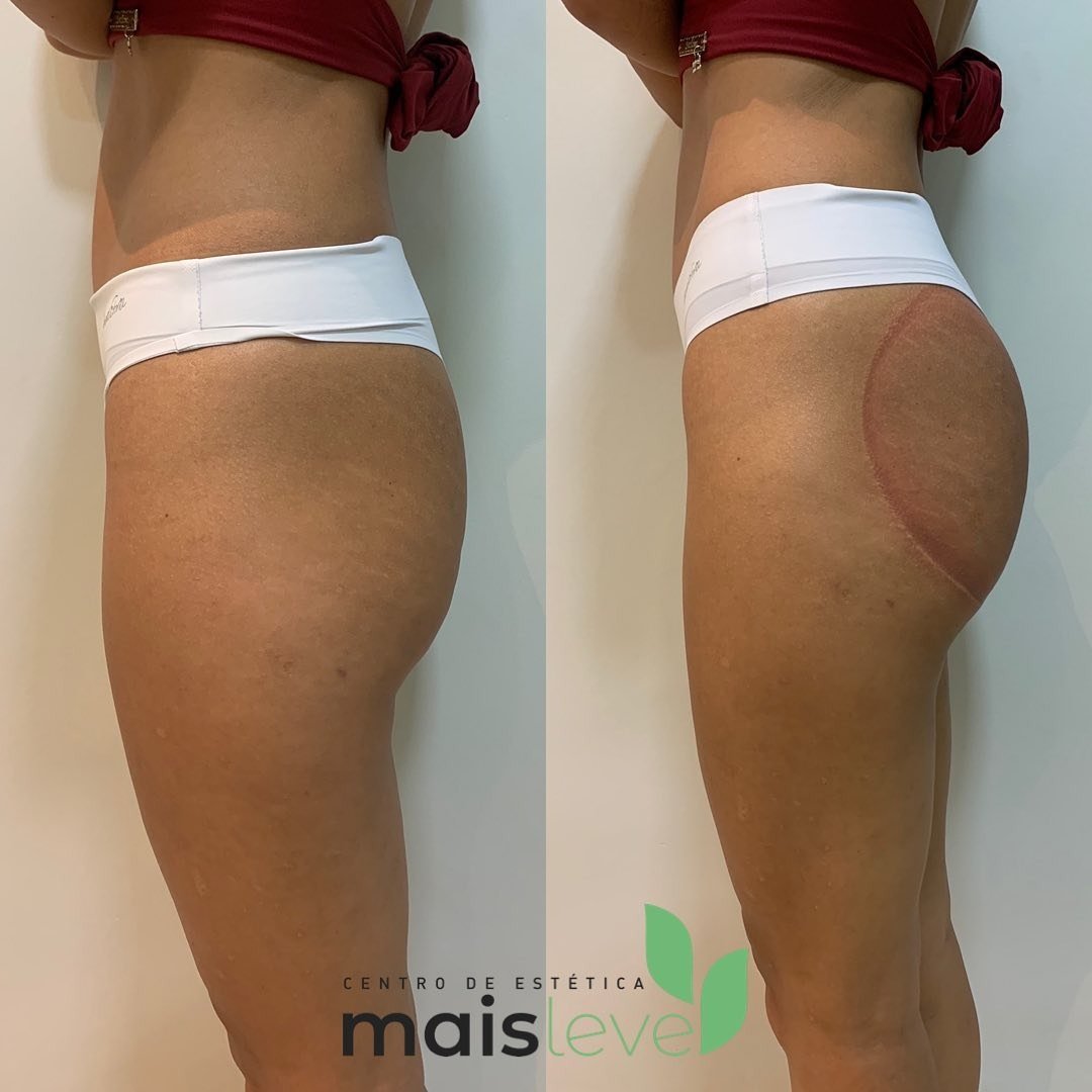 Antes e depois de procedimento corporal na região do glúteo