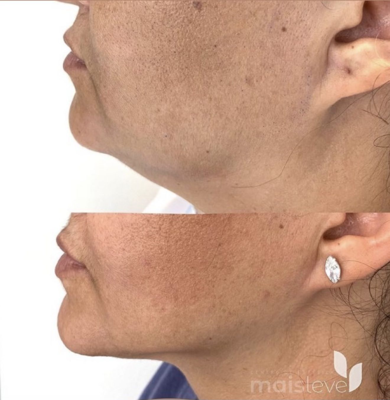 Antes e depois de procedimento facial na região do queixo e mandíbula