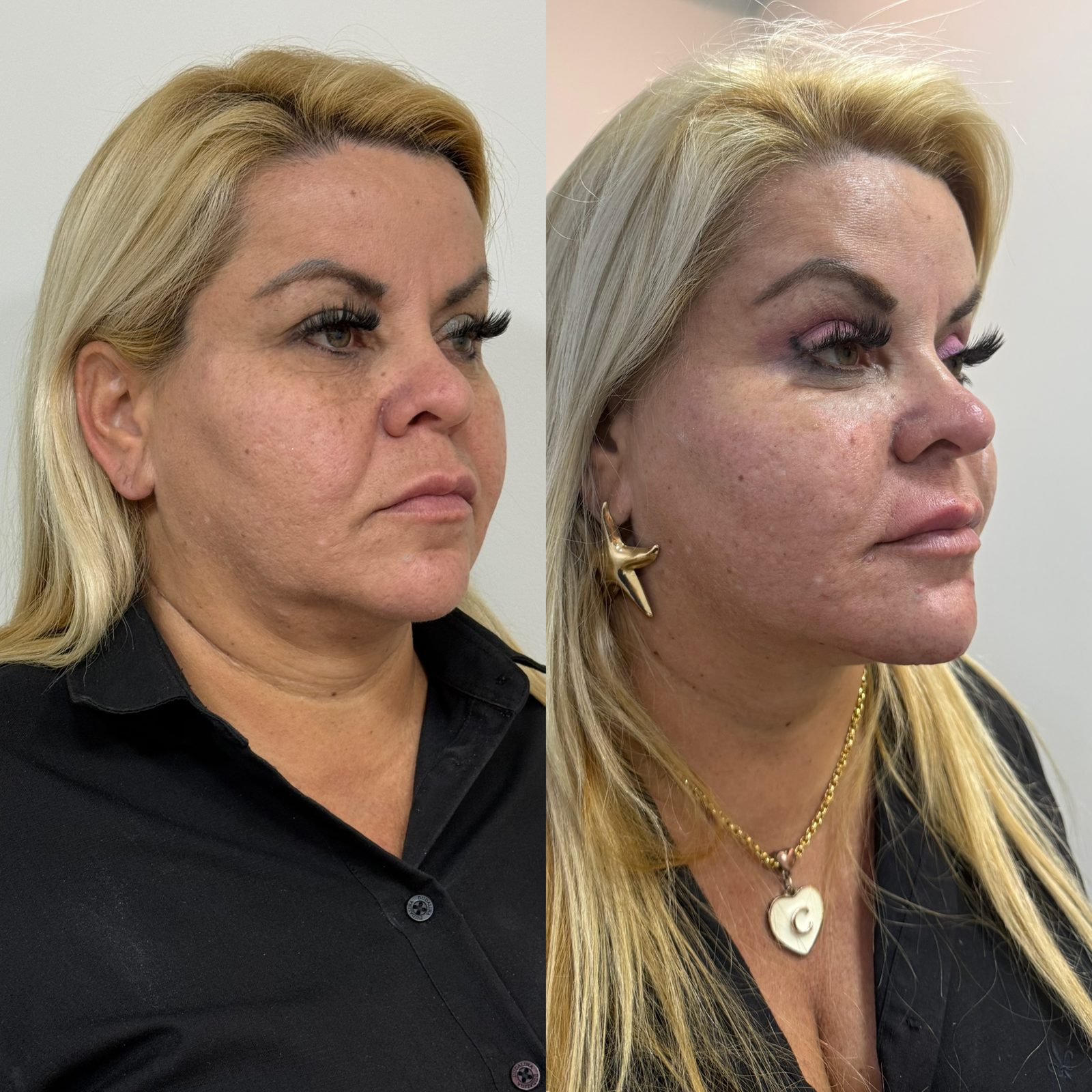Antes e depois de procedimento facial, rosto completo