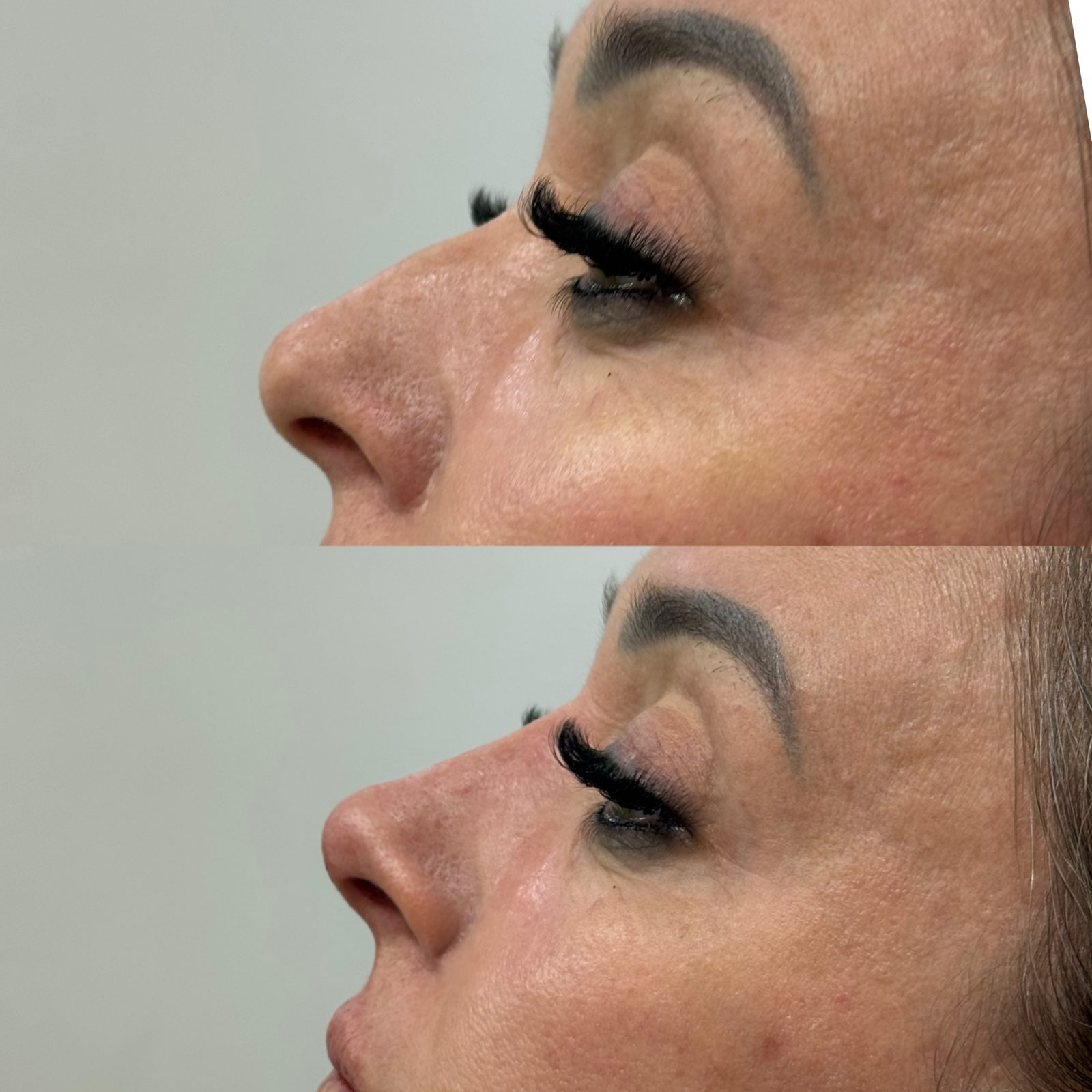 Antes e depois de procedimento facial na região dos olhos