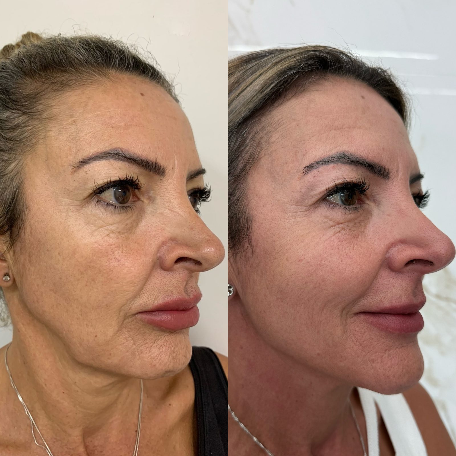 Antes e depois de procedimento facial, vista de perfil