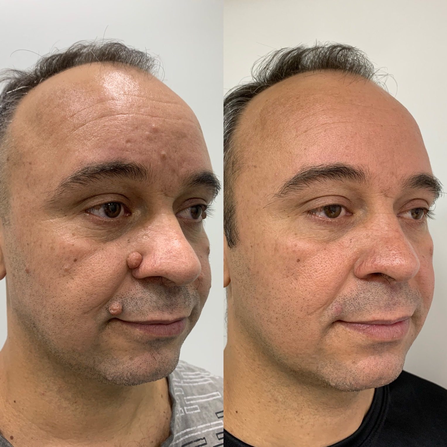 Antes e depois de procedimento facial na pele do rosto