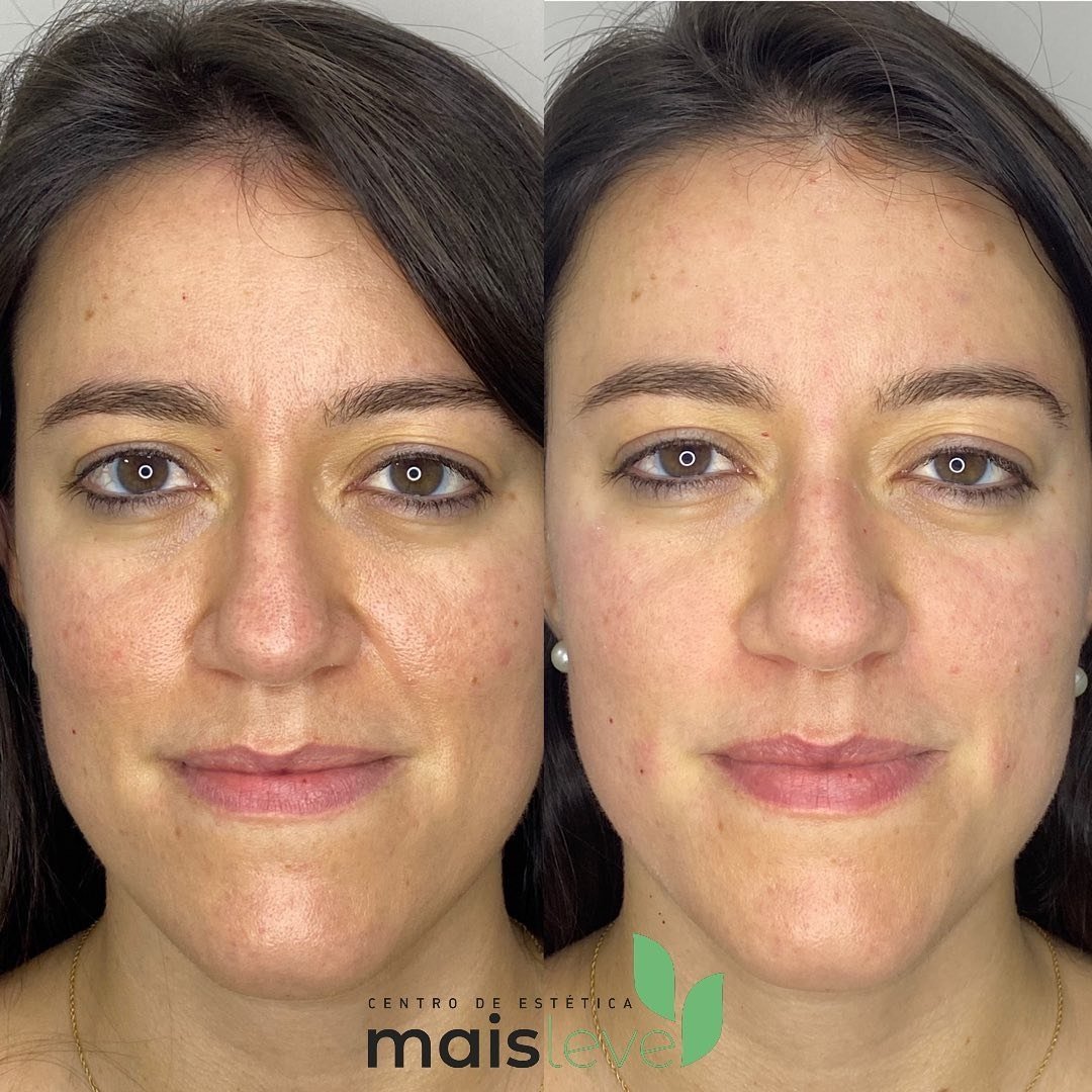 Antes e depois de procedimento facial, com melhora da textura da pele e olheiras
