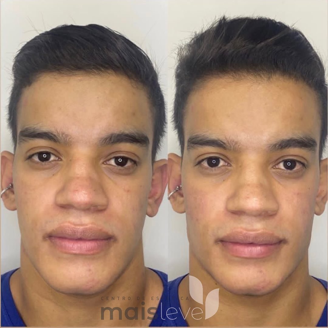 Antes e depois de procedimento facial masculino, vista frontal