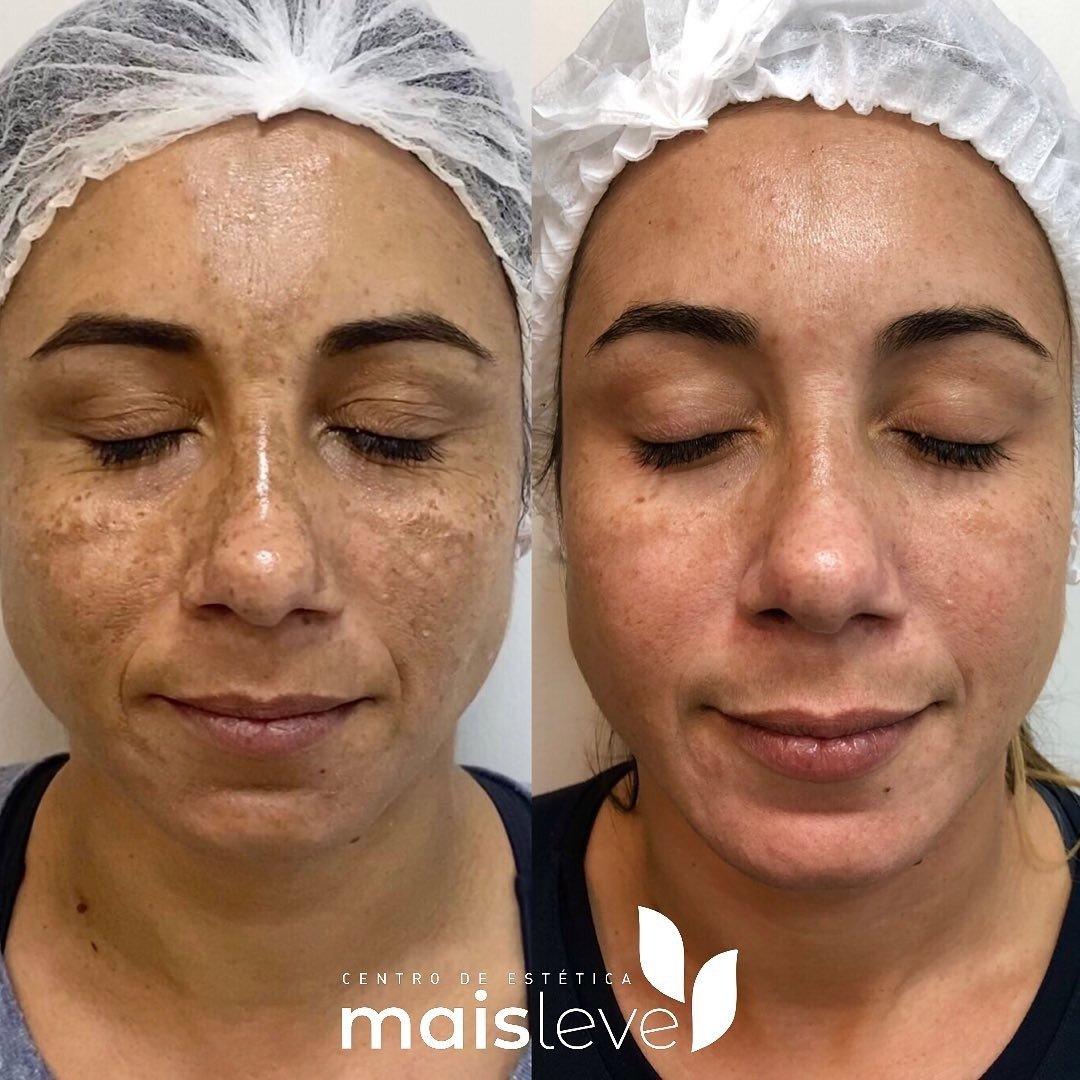 Antes e depois de tratamento para melasma com o Método SKIMS Melani, com clareamento das manchas