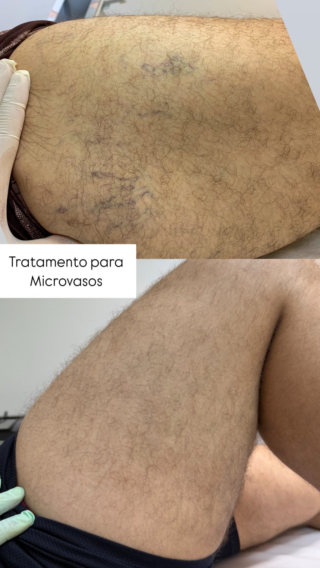 Antes e depois de tratamento para microvasos na coxa
