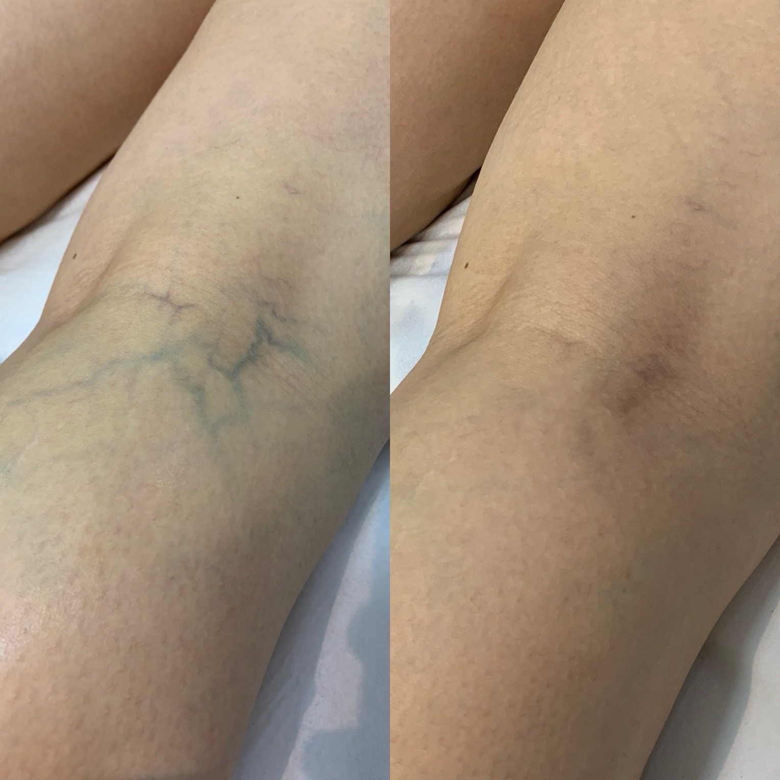 Antes e depois de tratamento para microvasos no braço