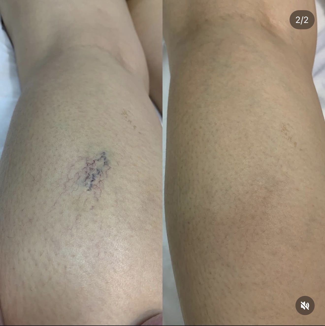 Antes e depois de tratamento para microvasos na perna